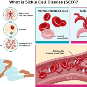 Sickle cell disease management anemia advances