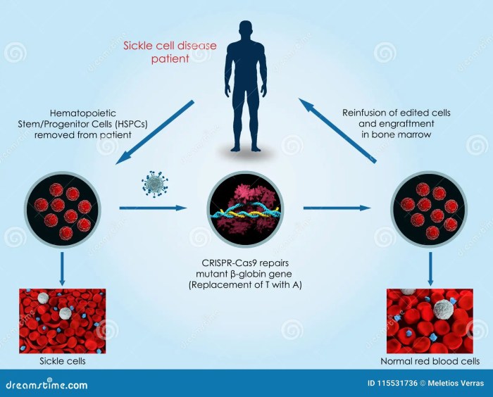 Sickle cell disease hydroxyurea treatment infographic health nhlbi scd heart used drug blood nih know crises who pain