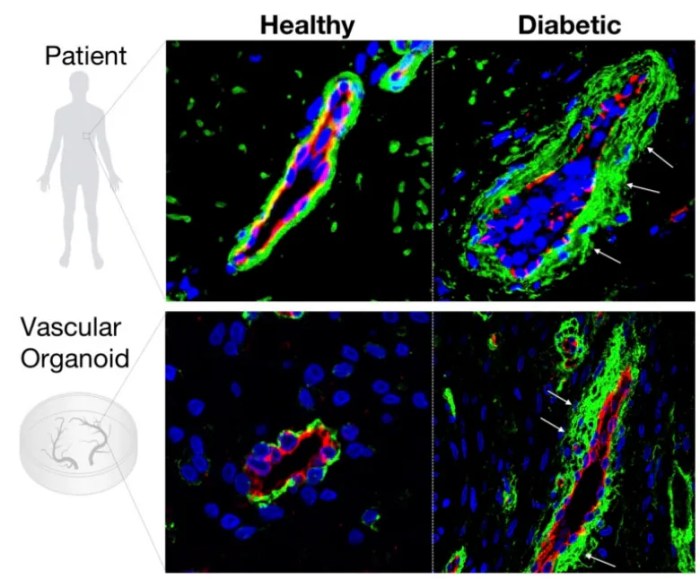 This blood vessel was grown in a lab with real human cells